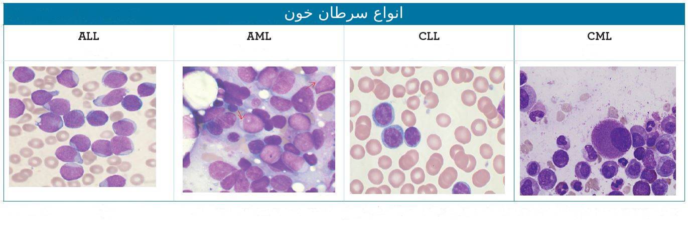 انواع سرطان خون