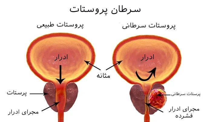 عکس سرطان پروستات