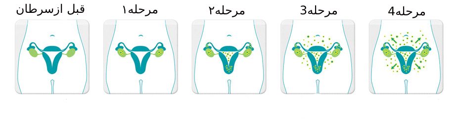 مراحل سرطان تخمدان
