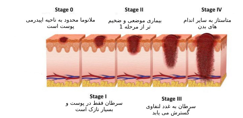 مراحل سرطان پوست