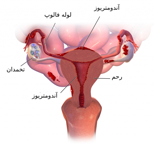 بیماری آندومتریوز