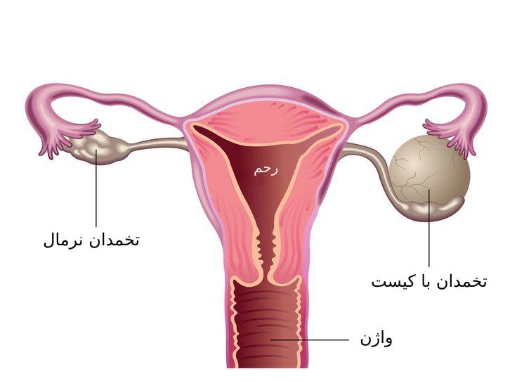 عکس کیست تخمدان