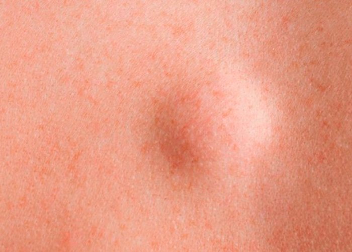 تومور پوستی لیپوما