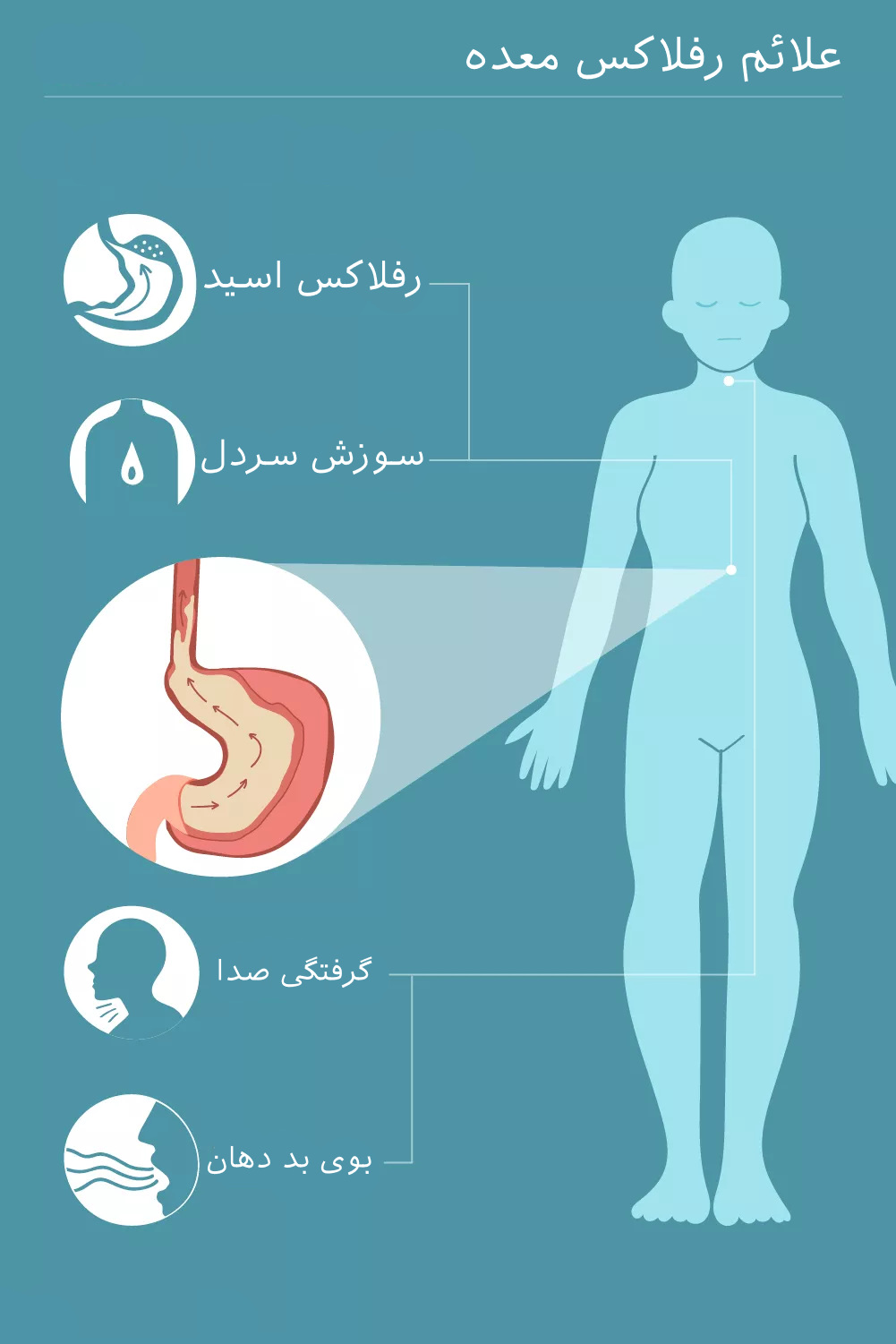 علائم رفلاکس معده