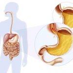 آشالازی چیست؟