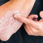 پسوریازیس-چیست؟