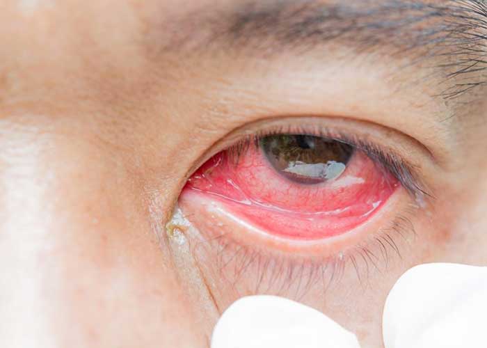 قرمزی چشم و-بیماری چشم صورتی