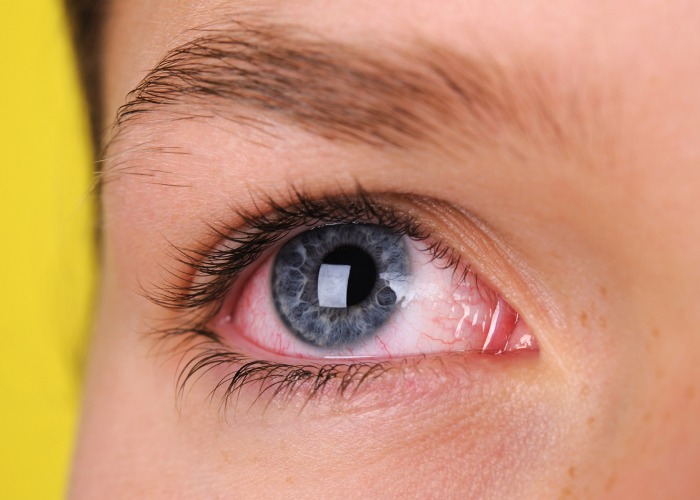آلرژی علت قرمزی چشم