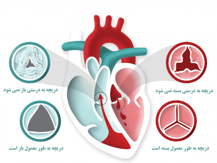 انواع بیماری دریچه قلب چیست؟
