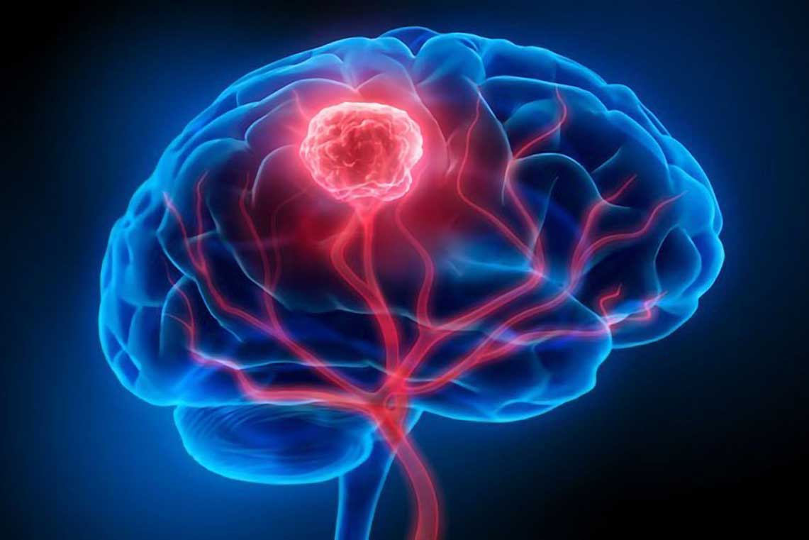 تومور مغزی چیست