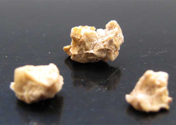 سنگ کلیه روی میز