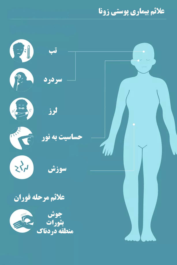 علائم زونا