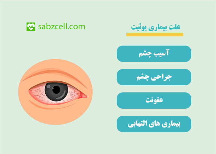 علت بیماری یوئیت چشمی