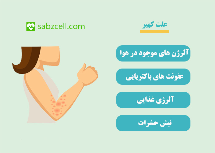 علت کهیر