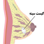 کیست-سینه-چیست