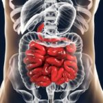 انسداد روده چیست