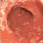 کولیت روده چیست