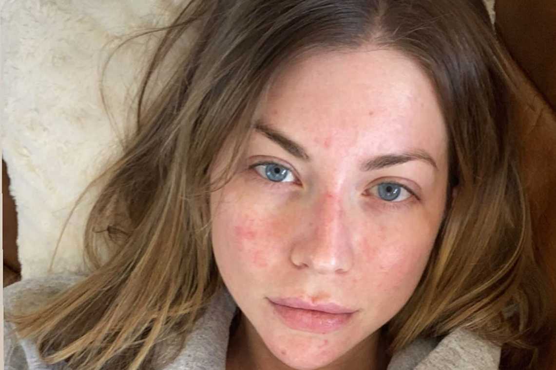 انواع پسوریازیس با عکس