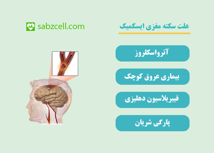 علت سکته مغزی ایسکمیک