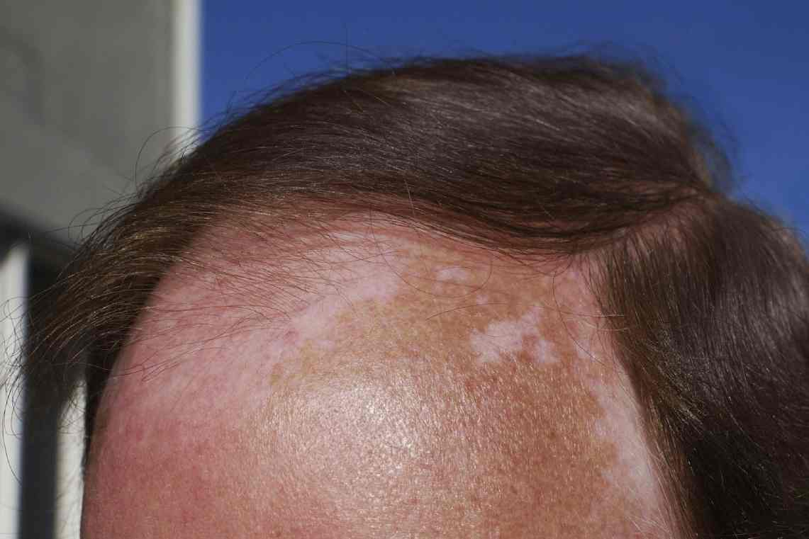 سرطان پوست در سر چیست
