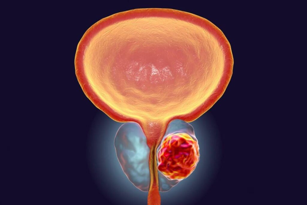 عود سرطان پروستات