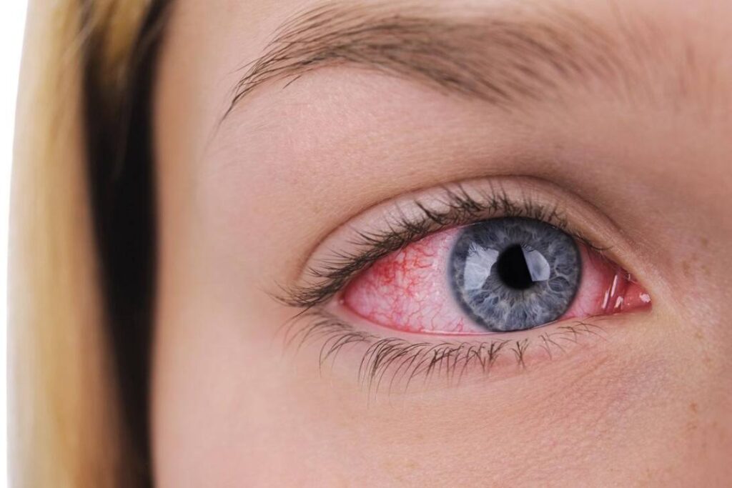 درمان خانگی قرمزی چشم
