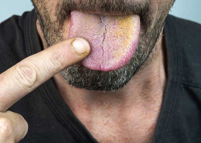 تکه زرد بر روی زبان