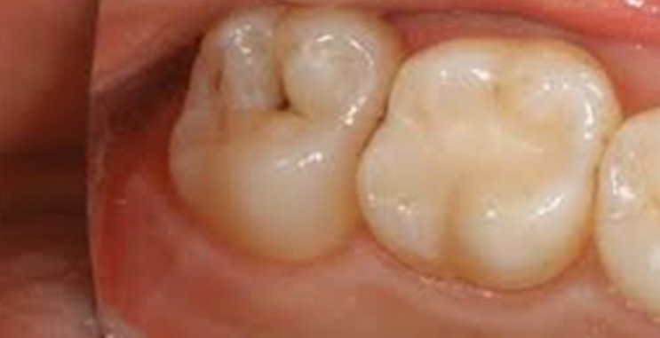  انواع پوسیدگی دندان سطح صاف
