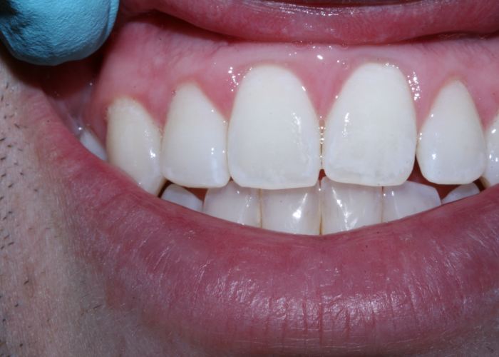 درمان لکه های سفید روی دندان