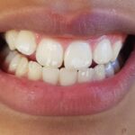 لکه های سفید روی دندان