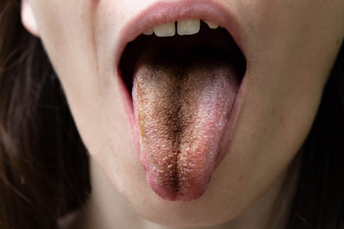 بیماری زبان مودار