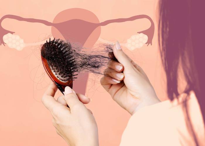 علائم ریزش موی مرتبط با تنبلی تخمدان