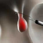 جراحی پولیپ روده بزرگ