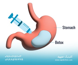 تزریق بوتاکس معده در کلینیک گوارش سپید