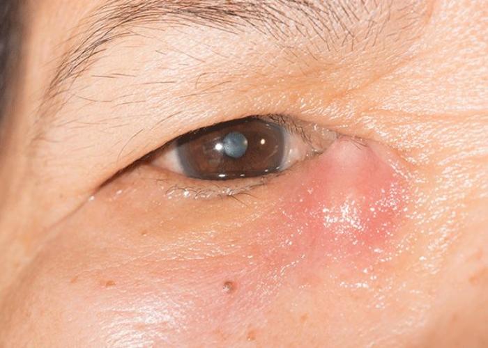 درد گوشه چشم بر اثر عفونت