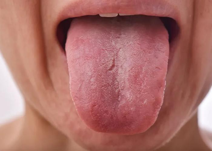 تورم زبان آلرژیک