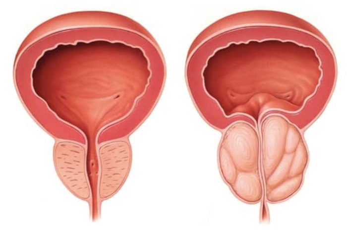بزرگ شدن پروستات