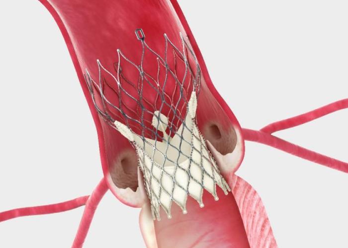 درمان تنگی آئورت (TAVR)