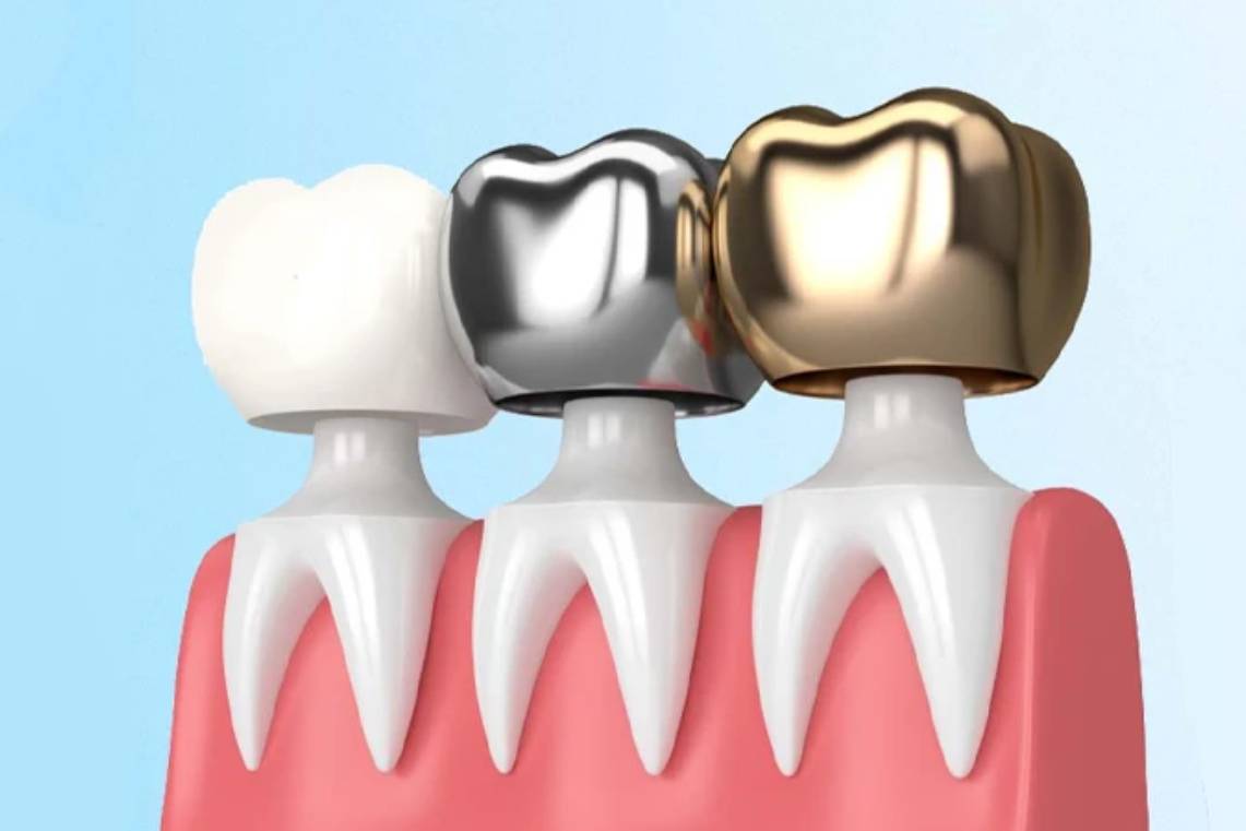 چگونه از روکش دندان خود مراقبت کنیم
