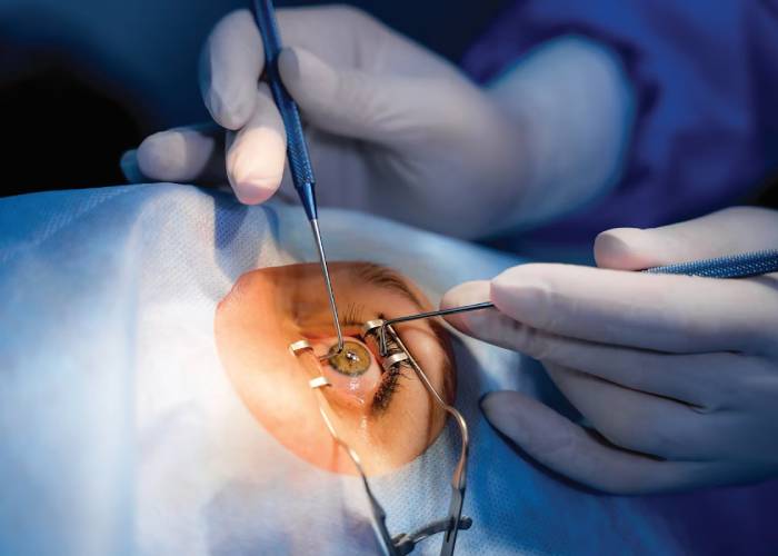 عمل کراتوپیگمنتاسیون