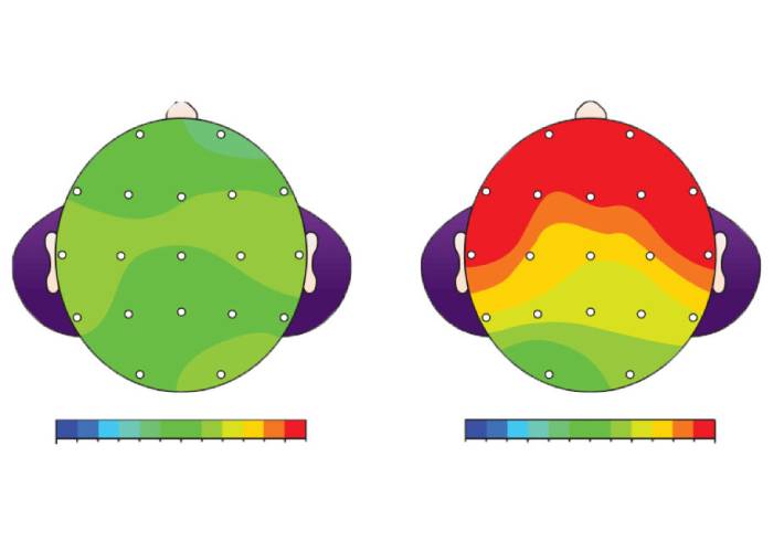 QEEG