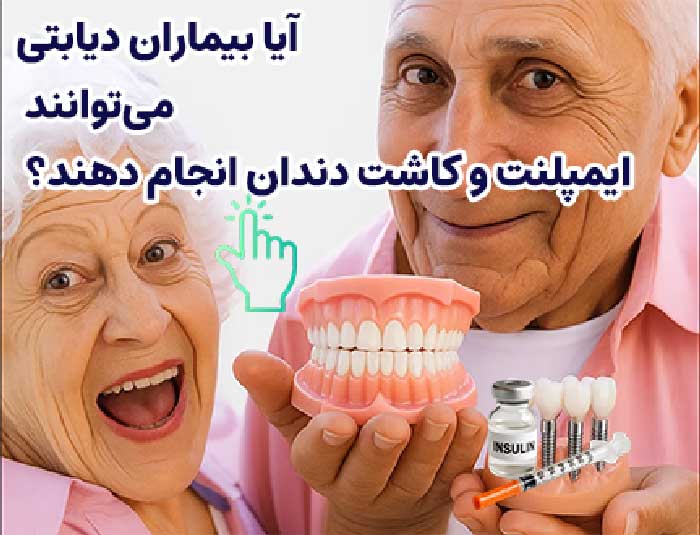 قیمت کاشت دندان مصنوعی کامل