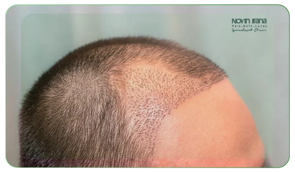علت ریزش موهای کاشته‌شده بعد از یک سال