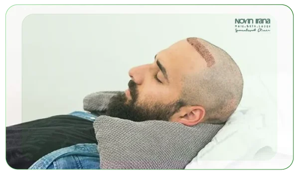 نقش خواب شبانه در ترمیم فولیکول‌ها