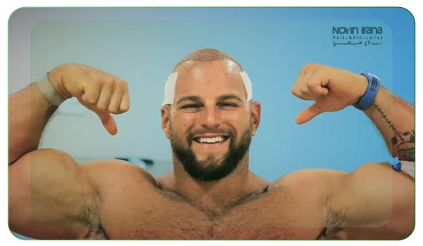 ورزش و فعالیت بدنی بعد از کاشت مو