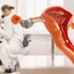 آیا آندومتریوز باعث ناباروری می‌شود