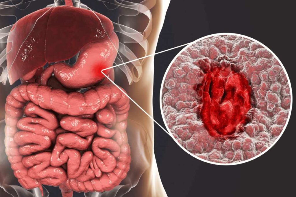 تفاوت زخم معده و سرطان معده