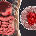 تفاوت زخم معده و سرطان معده