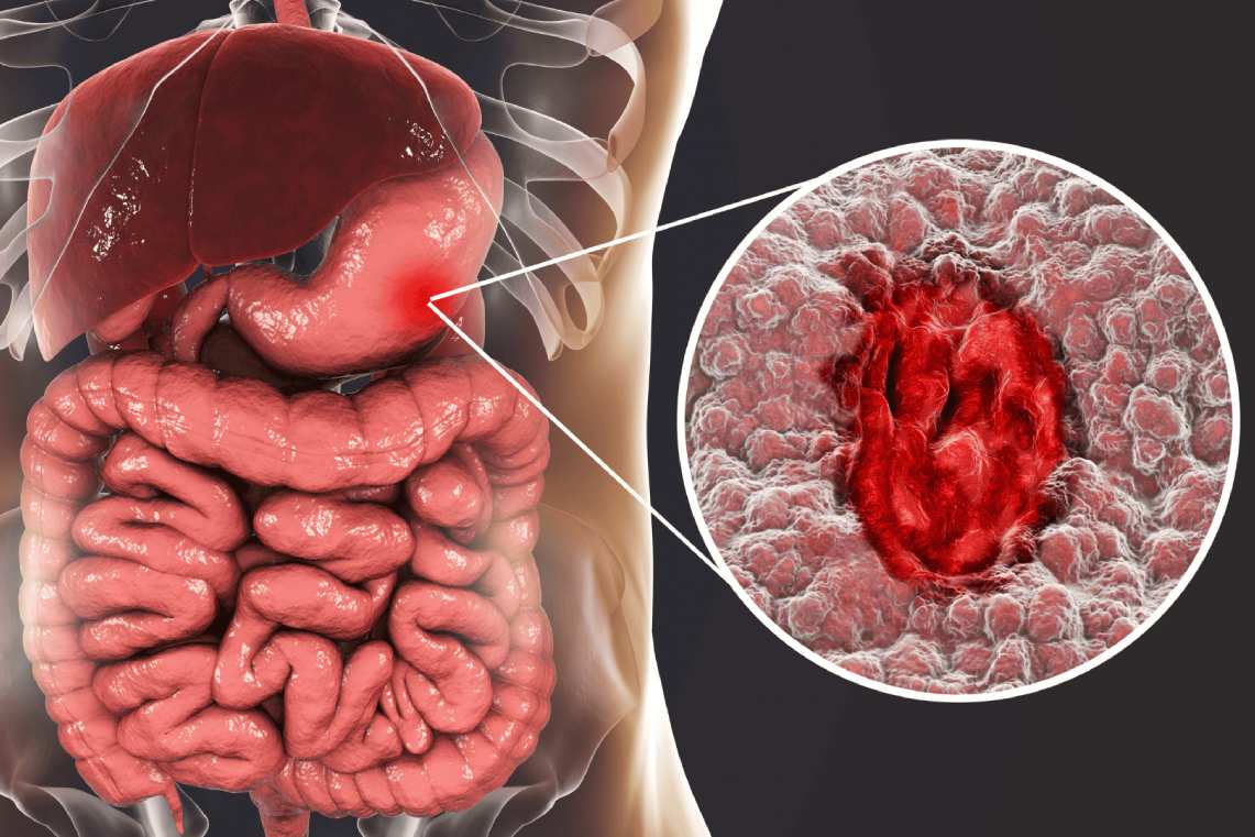 تفاوت زخم معده و سرطان معده