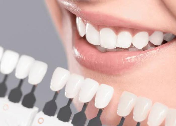 لمینت ایمکس (e-Max)